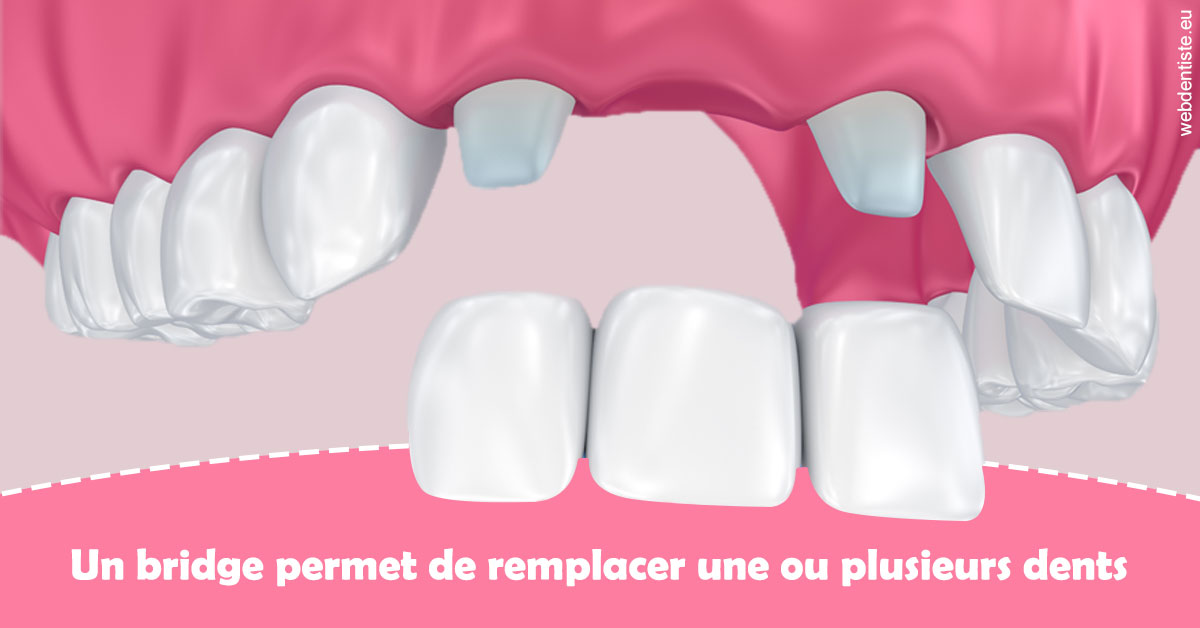 https://selarl-centre-dentaire-arceaux.chirurgiens-dentistes.fr/Bridge remplacer dents 2