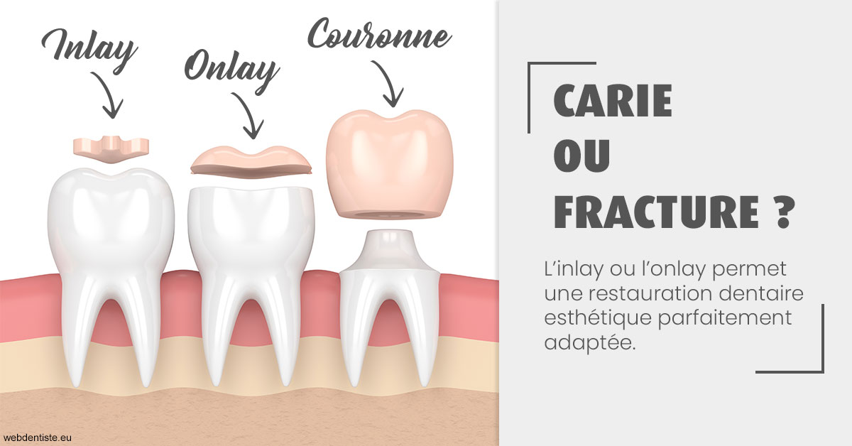 https://selarl-centre-dentaire-arceaux.chirurgiens-dentistes.fr/T2 2023 - Carie ou fracture 1