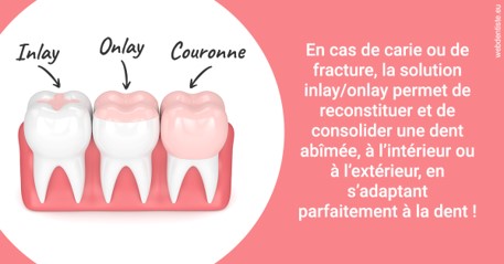 https://selarl-centre-dentaire-arceaux.chirurgiens-dentistes.fr/L'INLAY ou l'ONLAY 2