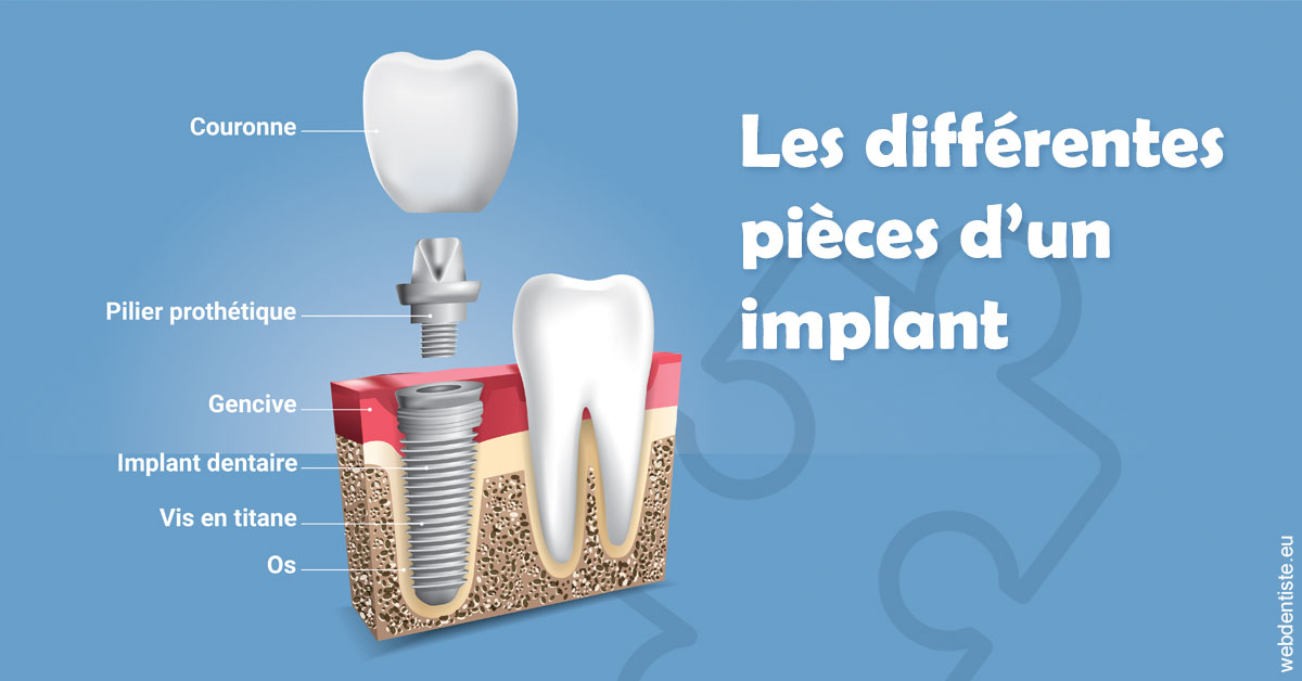 https://selarl-centre-dentaire-arceaux.chirurgiens-dentistes.fr/Les différentes pièces d’un implant 1